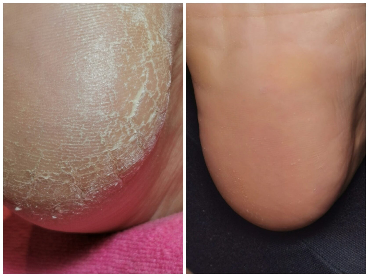 Dry Pedicure & Podo Disc senza kit